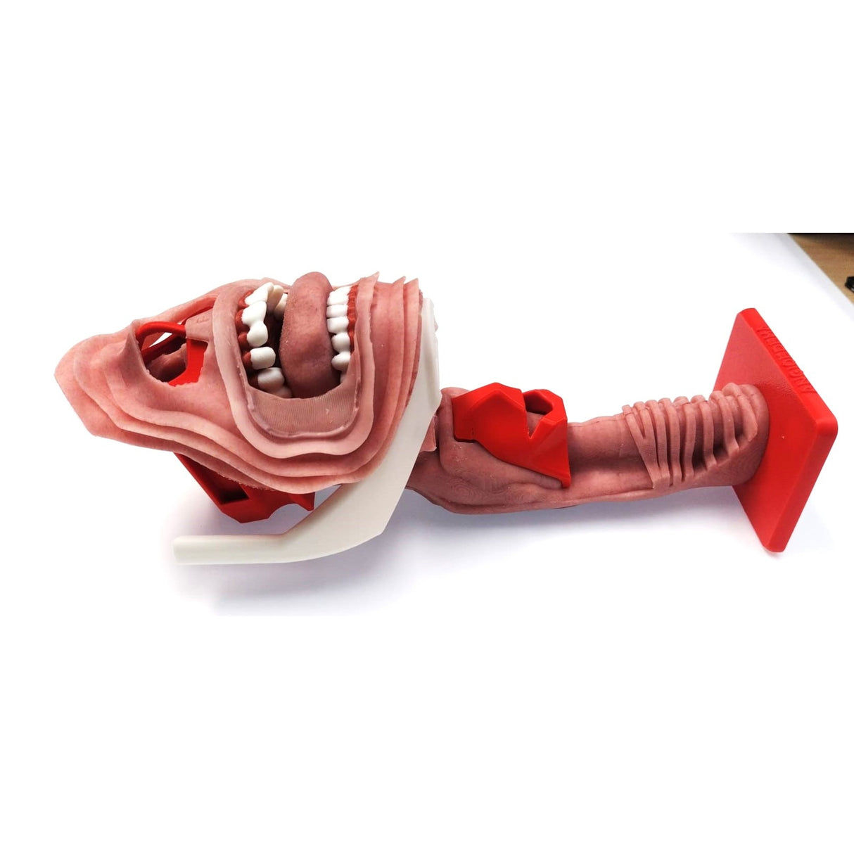 Angioedema Difficult Airway