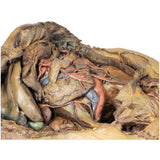 Abdomen with inguinal hernia | EZ-MP1133 | Sim & Skills Ltd