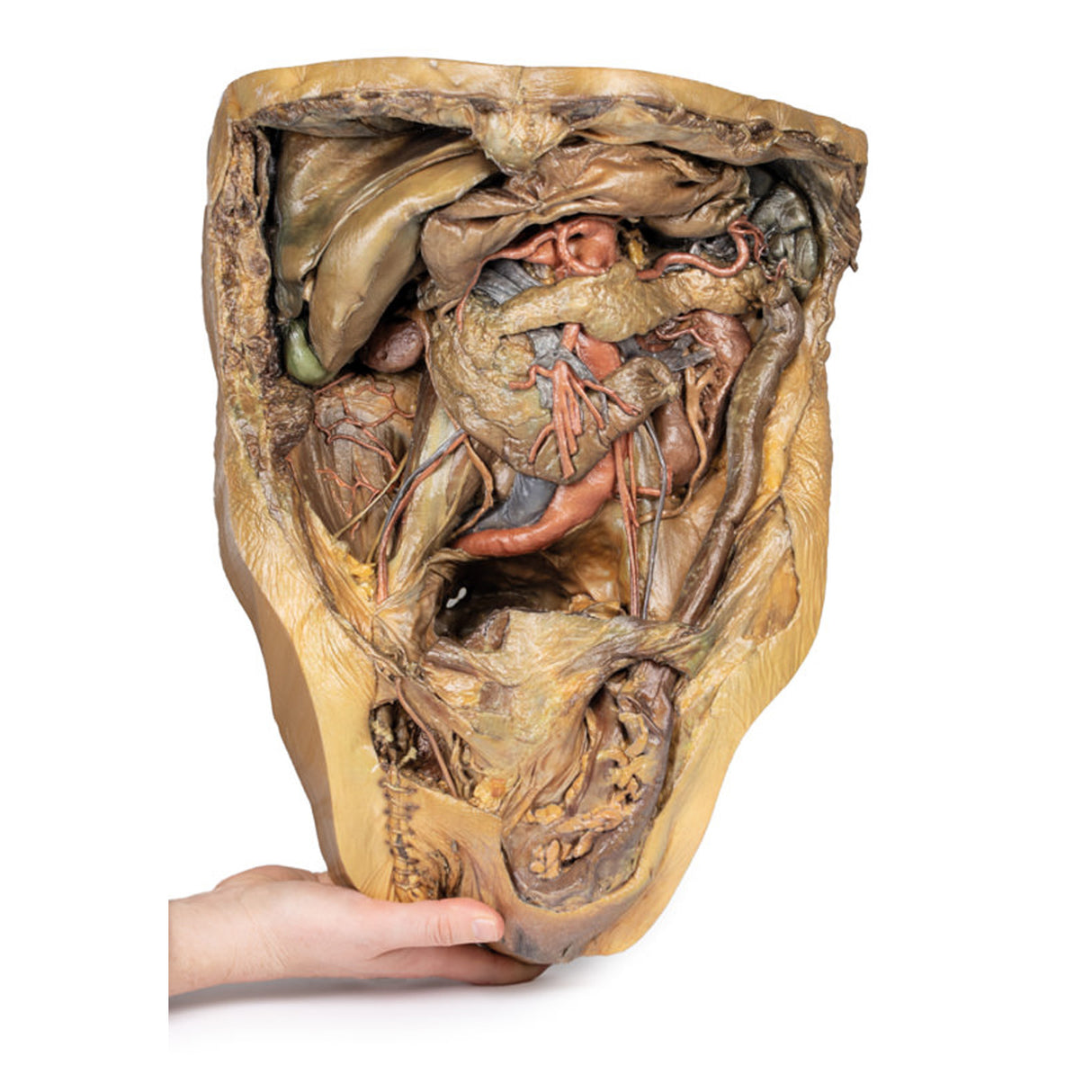 Abdomen with inguinal hernia | EZ-MP1133 | Sim & Skills Ltd