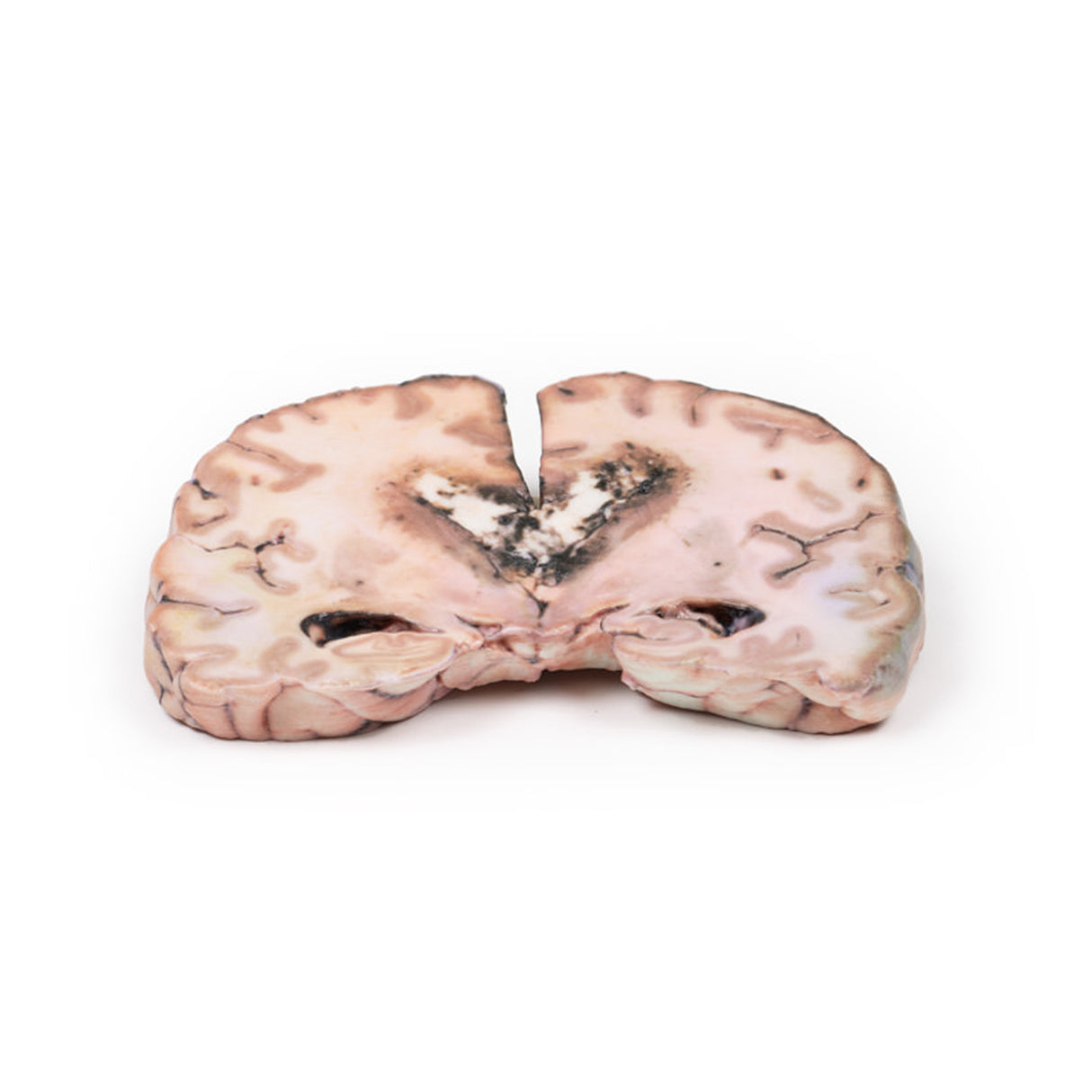 Glioma grade 3-4, causing papilloedema | EZ-2003 | Sim & Skills Ltd