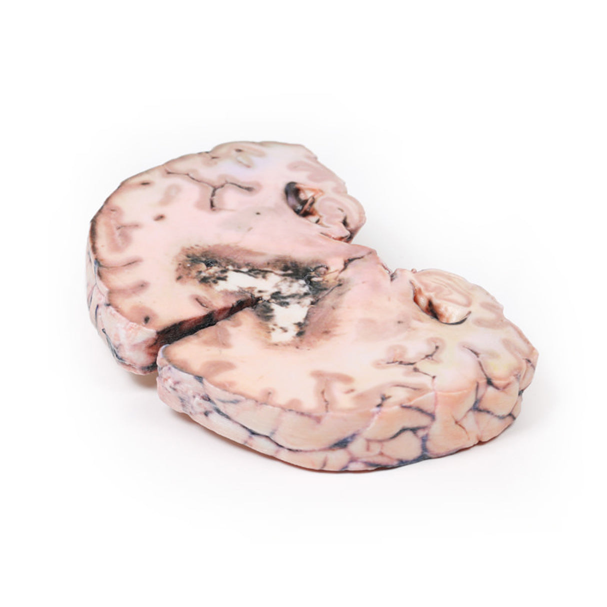 Glioma grade 3-4, causing papilloedema | EZ-2003 | Sim & Skills Ltd