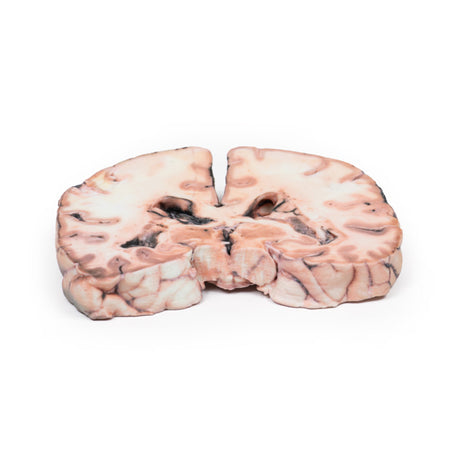 Glioma grade 3-4, causing papilloedema | EZ-2003 | Sim & Skills Ltd