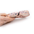 Glioma grade 3-4, causing papilloedema | EZ-2003 | Sim & Skills Ltd