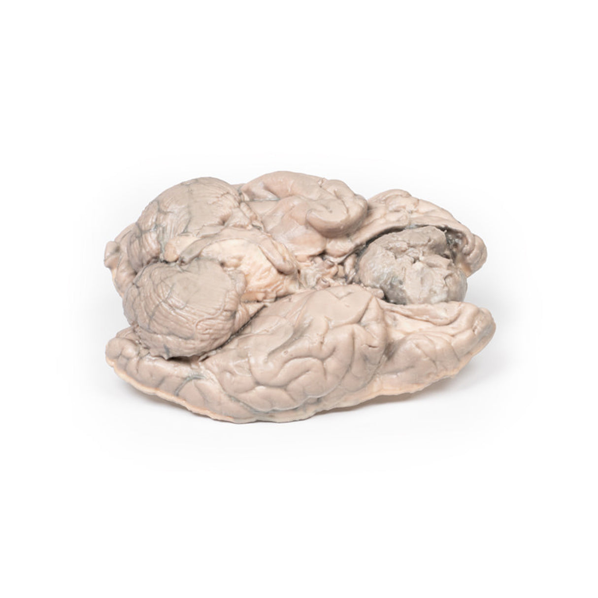 Meningioma | EZ-MP2004 | Sim & Skills Ltd
