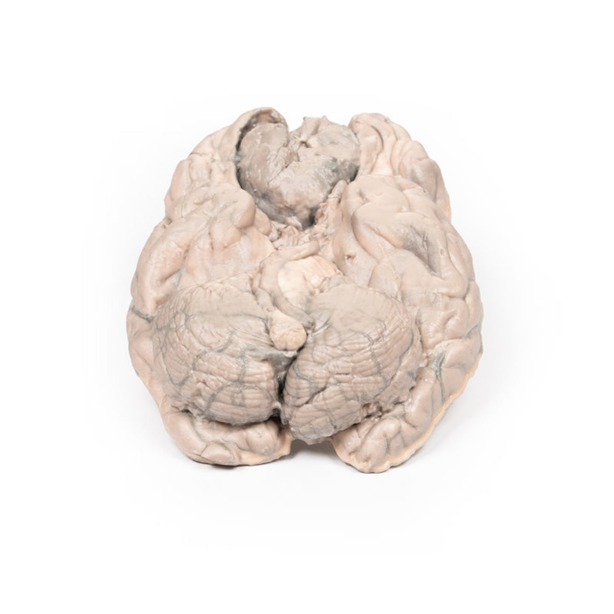 Meningioma | EZ-MP2004 | Sim & Skills Ltd