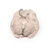 Meningioma | EZ-MP2004 | Sim & Skills Ltd