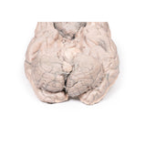 Meningioma | EZ-MP2004 | Sim & Skills Ltd