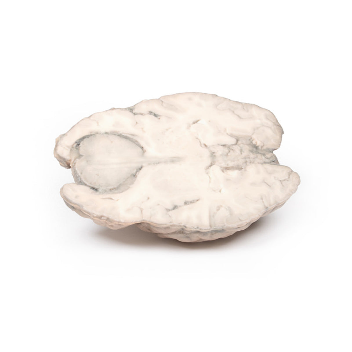 Meningioma | EZ-MP2004 | Sim & Skills Ltd
