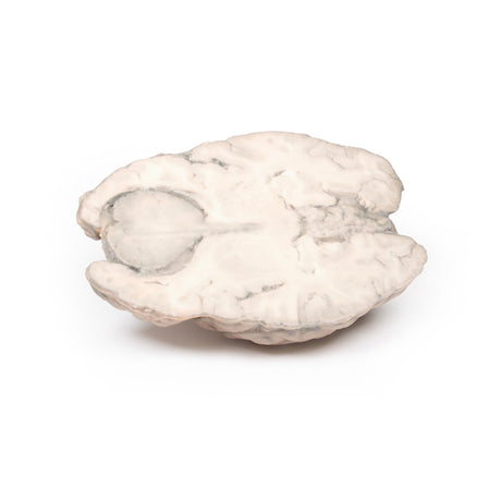 Meningioma | EZ-MP2004 | Sim & Skills Ltd
