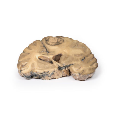 Metastatic Adenocarcinoma in the Brain | EX-MP2007 | Sim & Skills Ltd