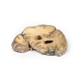 Metastatic Adenocarcinoma in the Brain | EX-MP2007 | Sim & Skills Ltd