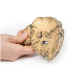 Metastatic Adenocarcinoma in the Brain | EX-MP2007 | Sim & Skills Ltd