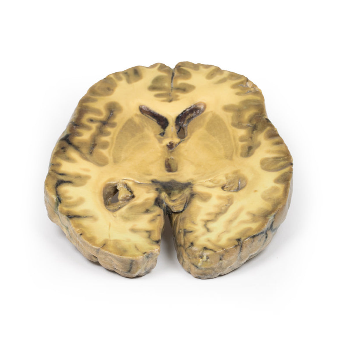 Ventriculitis, Secondary to Septicaemia | EZ-MP2008 | Sim & Skills Ltd