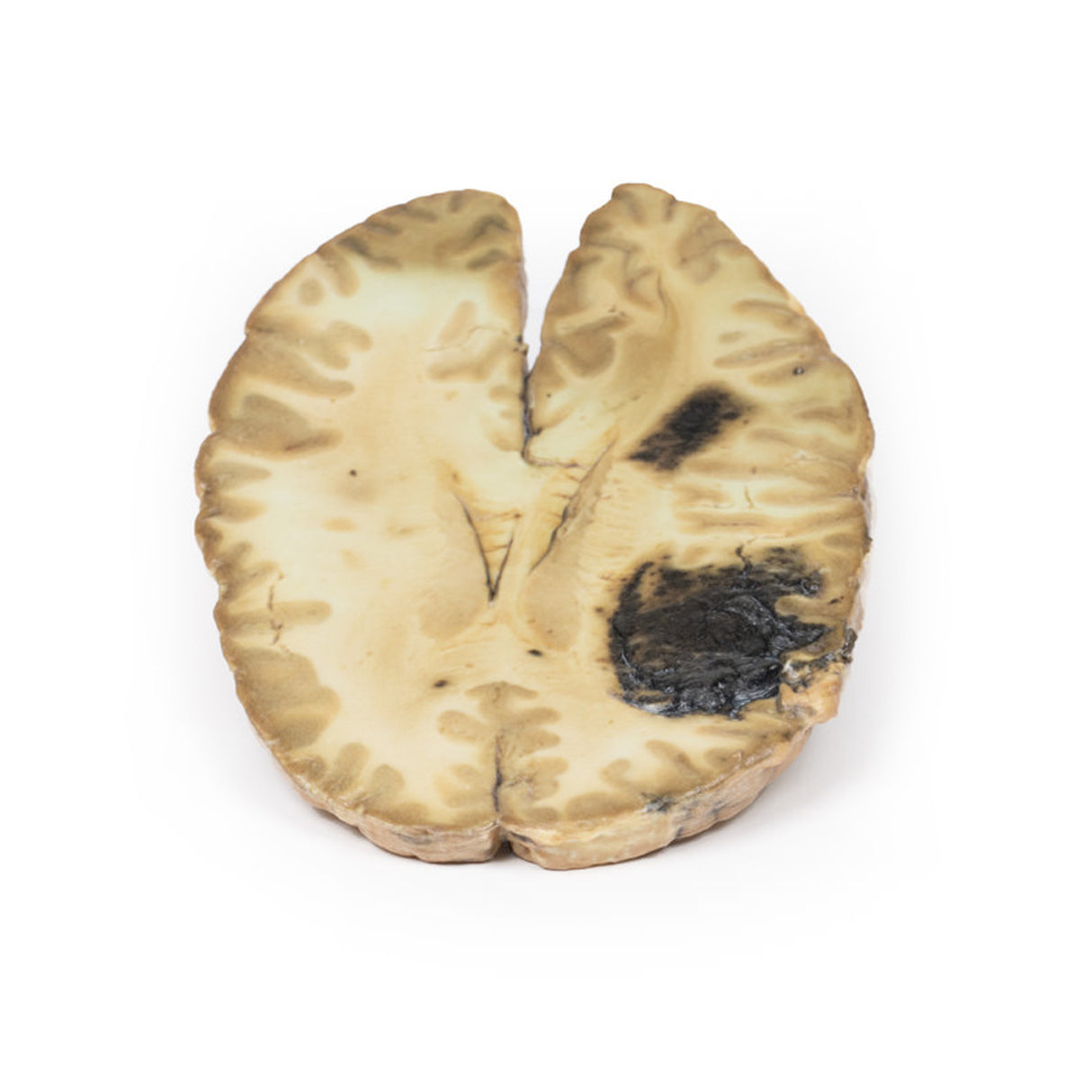 Cerebral Haemorrhage, secondary to Acute Myeloid Leukaemia | EZ-MP2009 | Sim & Skills Ltd