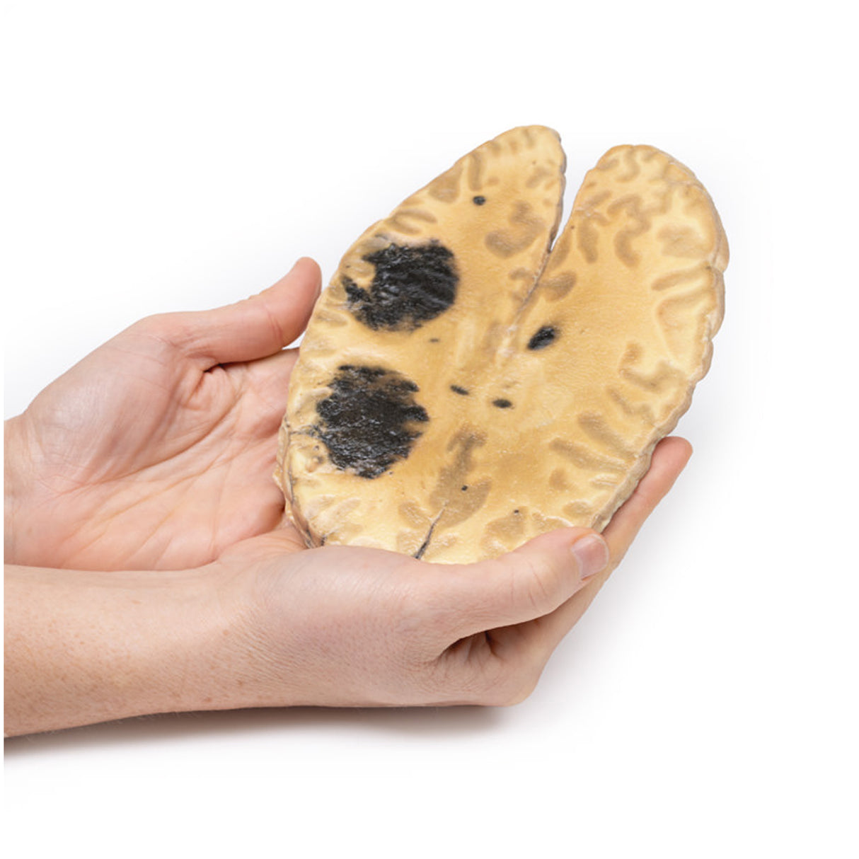 Cerebral Haemorrhage, secondary to Acute Myeloid Leukaemia | EZ-MP2009 | Sim & Skills Ltd