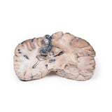Cerebral Arterio-Venous Malformation | EZ-MP2010 | Sim & Skills Ltd