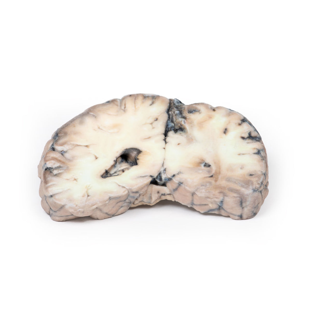 Cerebral Arterio-Venous Malformation | EZ-MP2010 | Sim & Skills Ltd