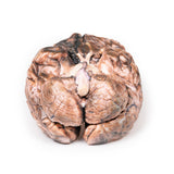 Ruptured Berry Aneurysm | EZ-MP2013 | Sim & Skills Ltd