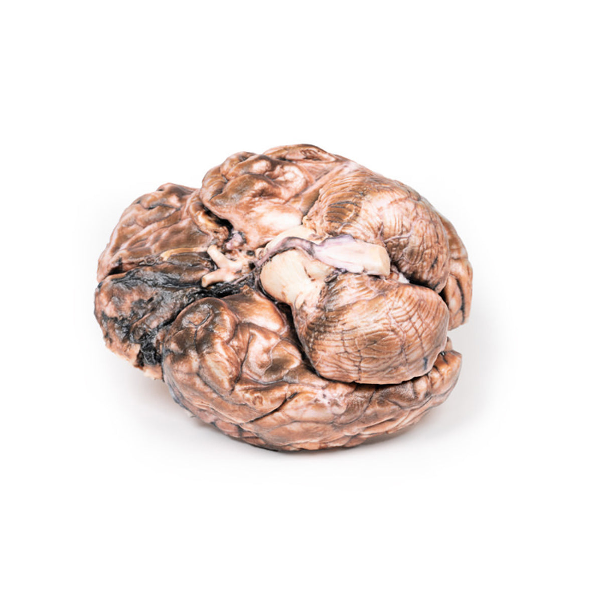 Ruptured Berry Aneurysm | EZ-MP2013 | Sim & Skills Ltd