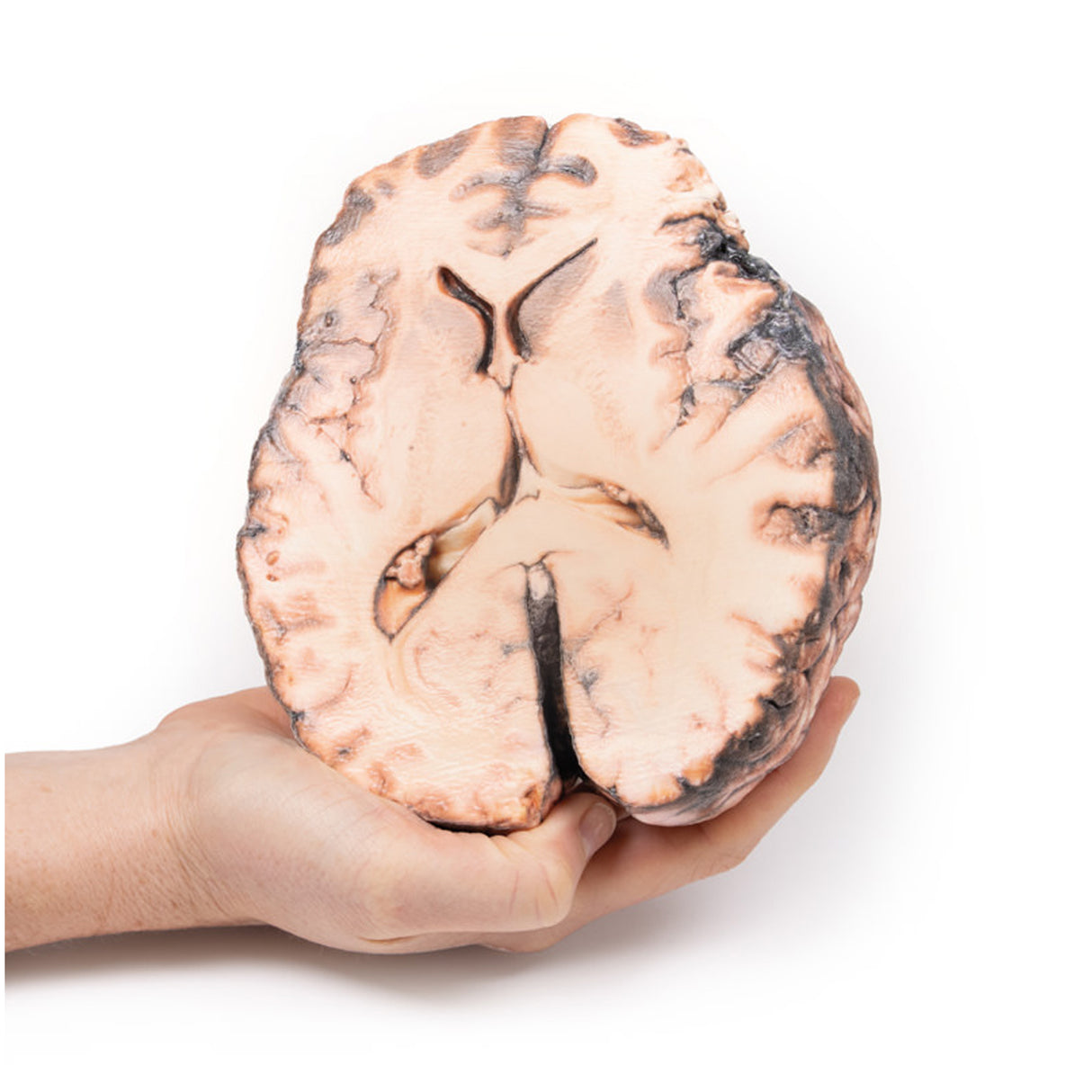 Ruptured Berry Aneurysm | EZ-MP2013 | Sim & Skills Ltd