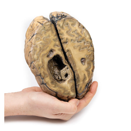 Metastatic carcinoma in the brain | EZ-MP2019 | Sim & Skills Ltd