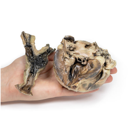 Hydatid Disease Affecting the Heart and Aorta | EZ-MP2035 | Sim & Skills Ltd