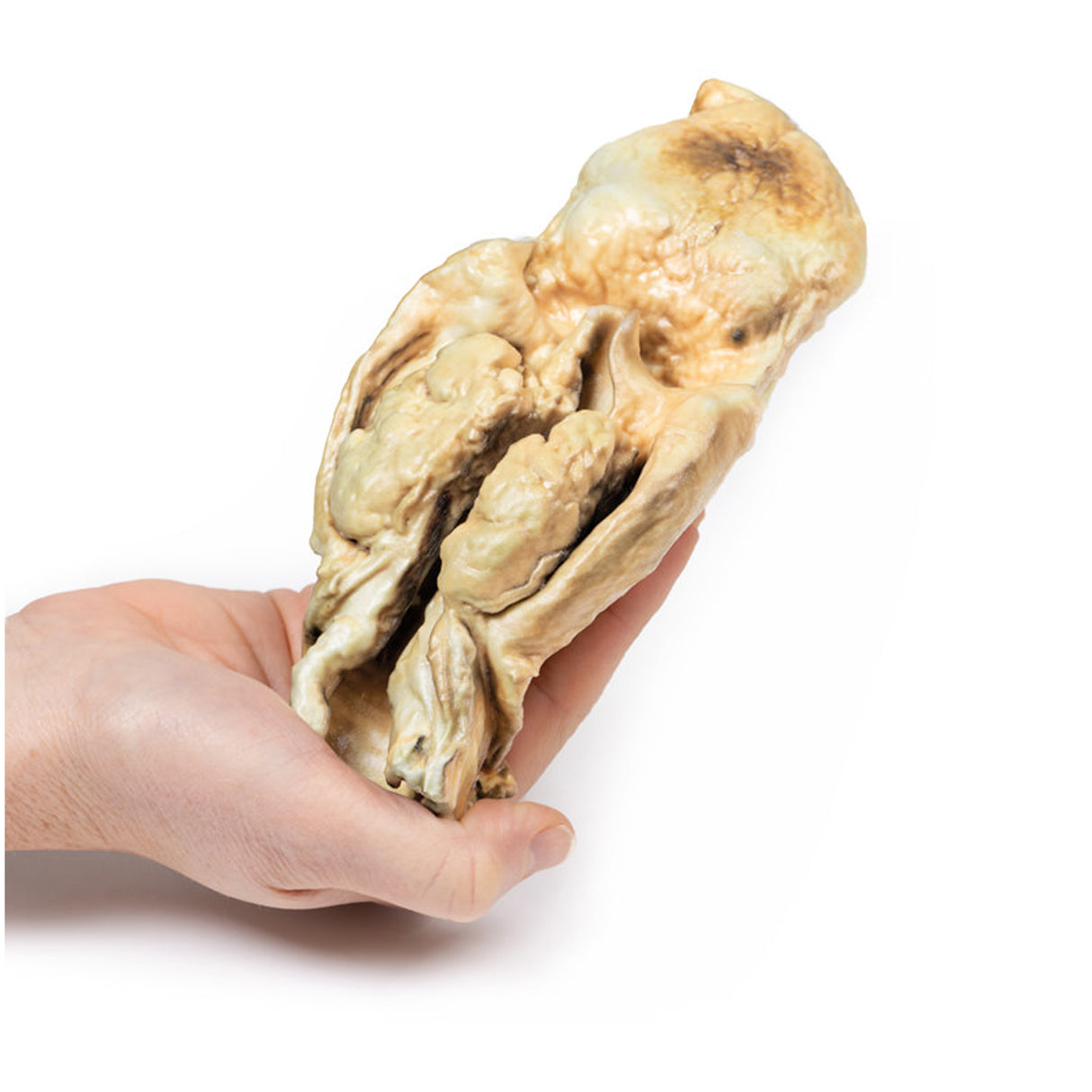 Carcinoma of Larynx | EZ-MP2050 | Sim & Skills Ltd