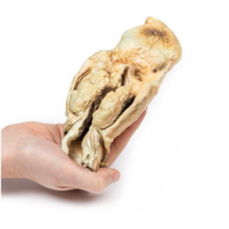 Carcinoma of Larynx | EZ-MP2050 | Sim & Skills Ltd