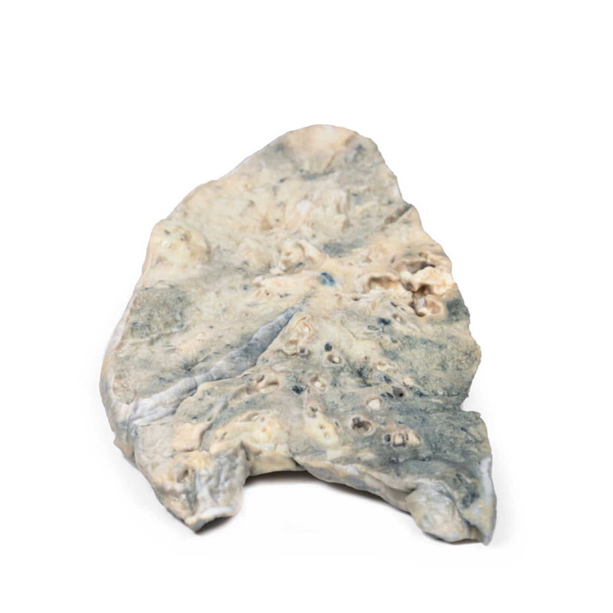 Lung - Staphylococcus aureus Abscesses | EZ-MP2064 | Sim & Skills Ltd