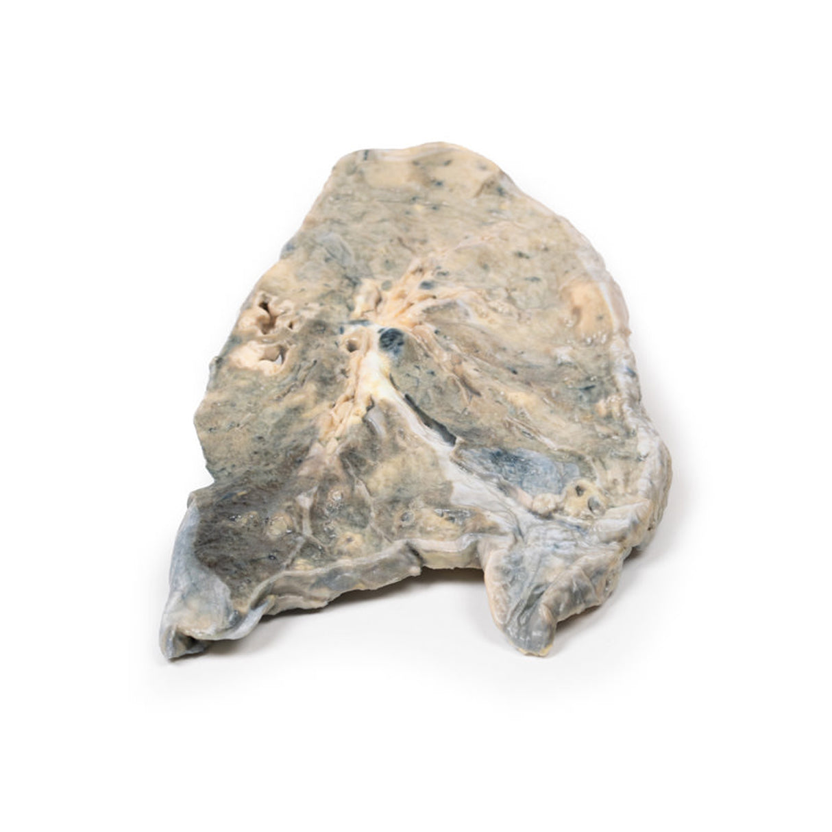 Lung - Staphylococcus aureus Abscesses | EZ-MP2064 | Sim & Skills Ltd