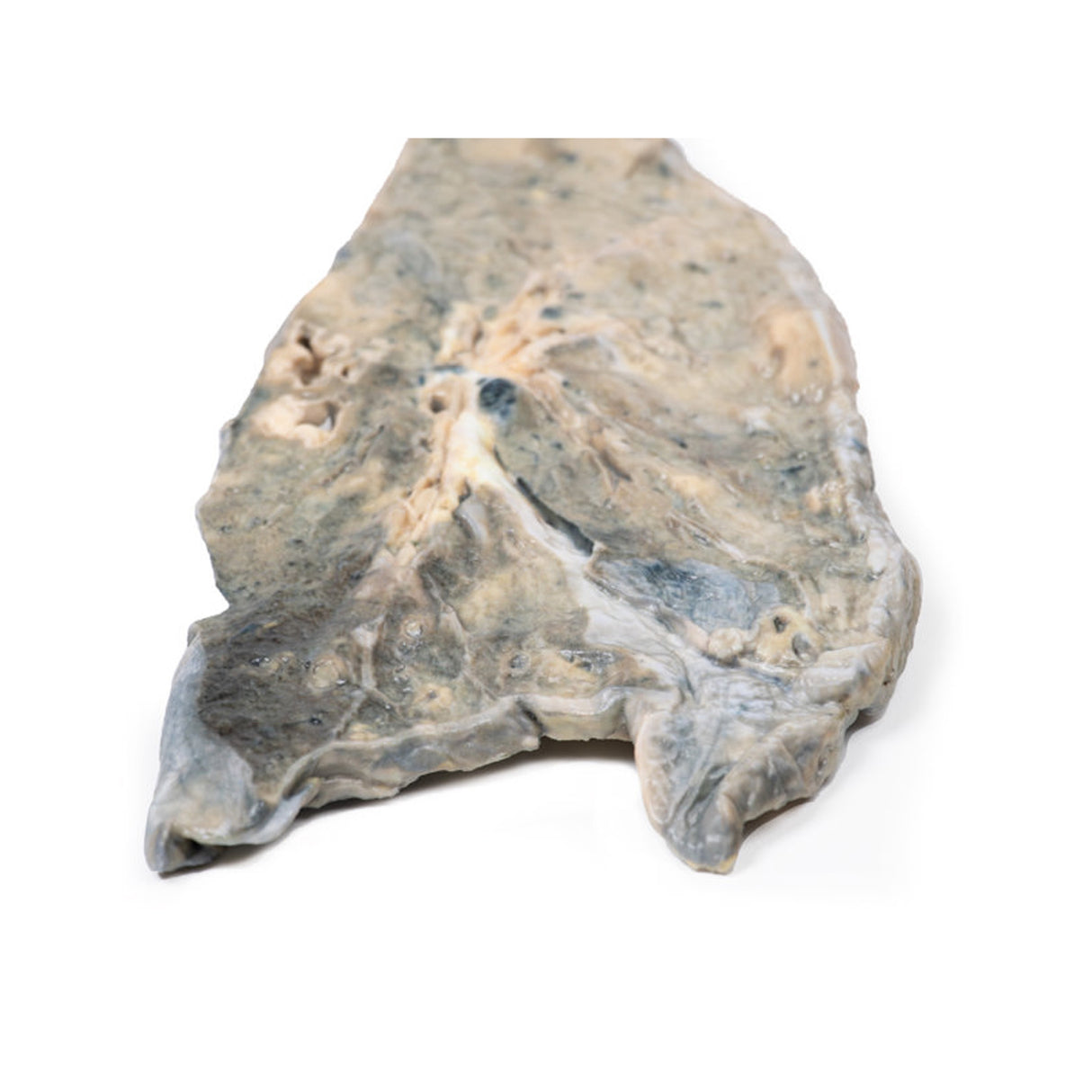 Lung - Staphylococcus aureus Abscesses | EZ-MP2064 | Sim & Skills Ltd