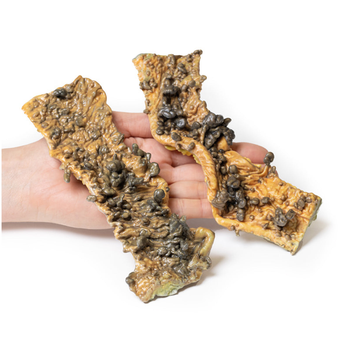 Multiple Polyposis Coli | EZ-MP2070 | Sim & Skills Ltd