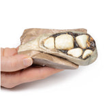 Cholelithiasis (Gallstones) | EZ-MP2075 | Sim & Skills Ltd