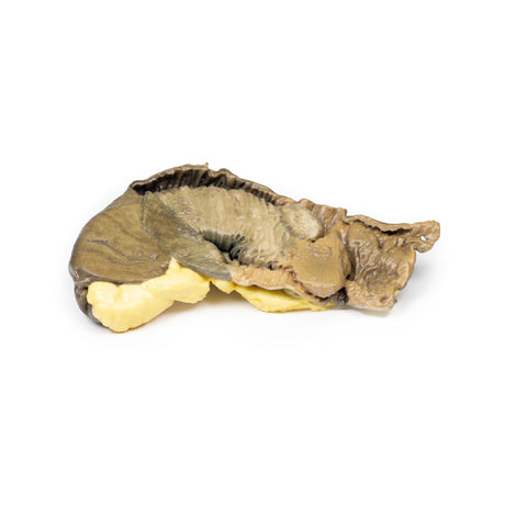 Intussusception of small bowel due to metastatic tumour | EZ-MP2077 | Sim & Skills Ltd
