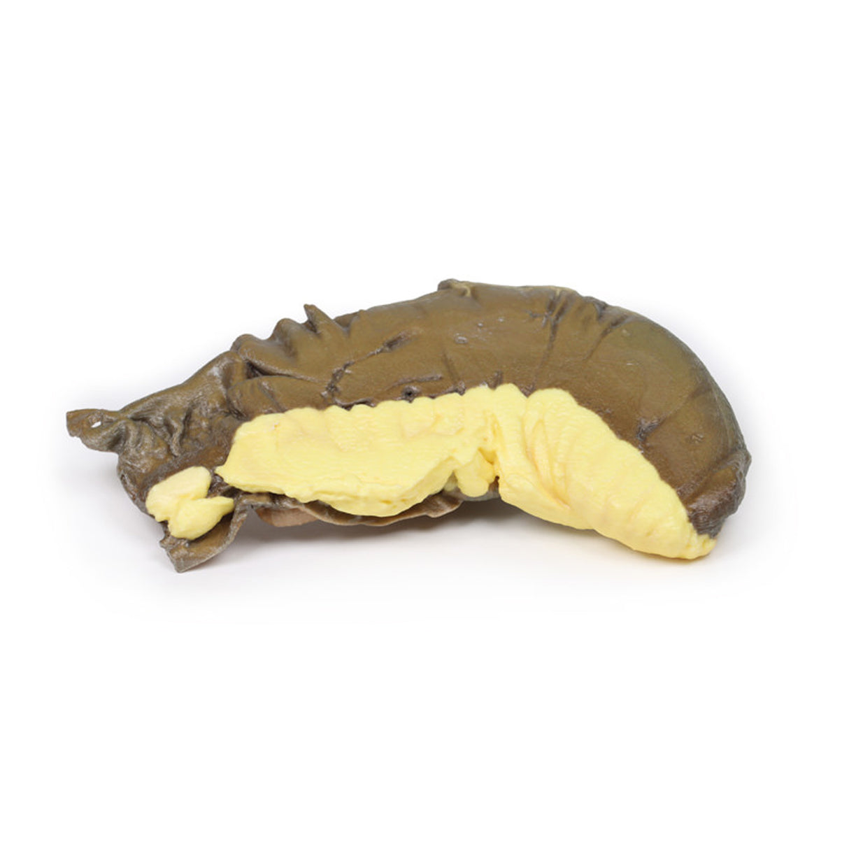 Intussusception of small bowel due to metastatic tumour | EZ-MP2077 | Sim & Skills Ltd