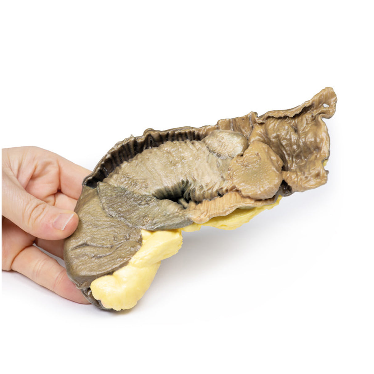Intussusception of small bowel due to metastatic tumour | EZ-MP2077 | Sim & Skills Ltd