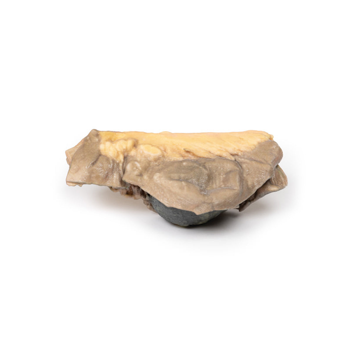 Gallstone Ileus | EZ-MP2078 | Sim & Skills Ltd