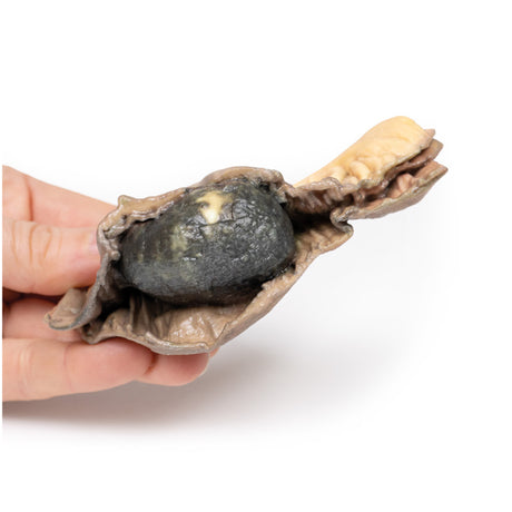 Gallstone Ileus | EZ-MP2078 | Sim & Skills Ltd