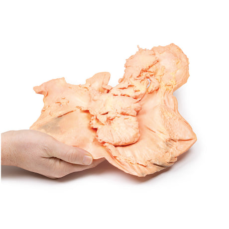 Adenocarcinoma of the stomach | EZ-MP2080 | Sim & Skills Ltd