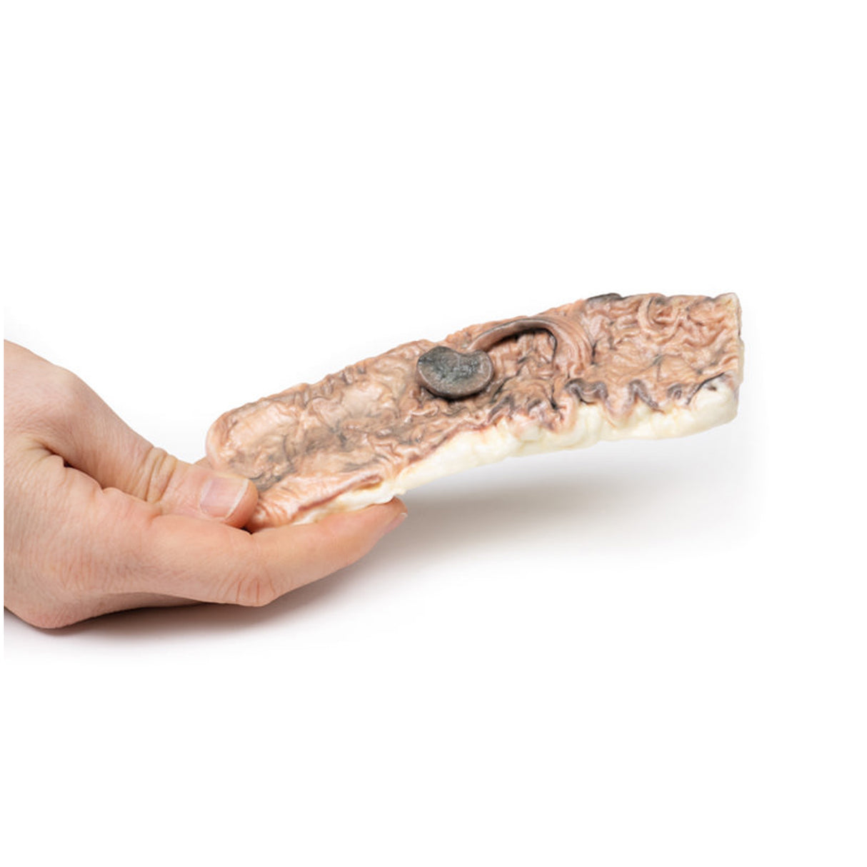 Pedunculated Adenoma of the Colon | EZ-MP2081 | Sim & Skills Ltd
