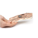 Pedunculated Adenoma of the Colon | EZ-MP2081 | Sim & Skills Ltd