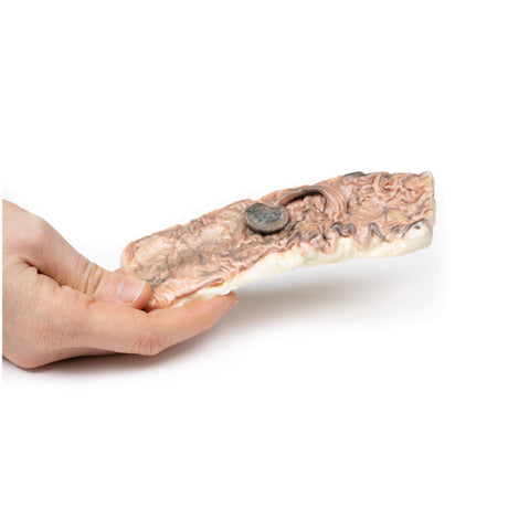 Pedunculated Adenoma of the Colon | EZ-MP2081 | Sim & Skills Ltd