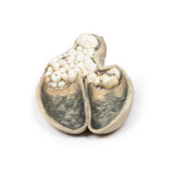 Cholecystitis and Cholelithiasis | EZ-MP2082 | Sim & Skills Ltd
