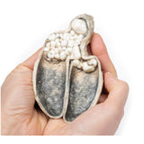 Cholecystitis and Cholelithiasis | EZ-MP2082 | Sim & Skills Ltd