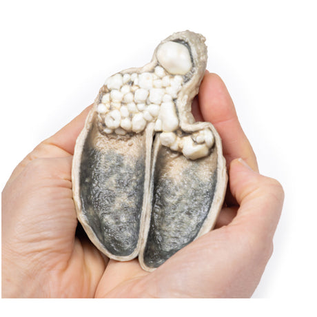 Cholecystitis and Cholelithiasis | EZ-MP2082 | Sim & Skills Ltd