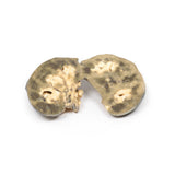 Horseshoe Kidney | EZ-MP2092 | Sim & Skills Ltd
