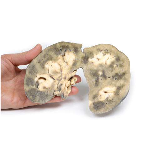 Horseshoe Kidney | EZ-MP2092 | Sim & Skills Ltd