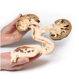 Hydronephrosis Hydroureter | EZ-MP2093 | Sim & Skills Ltd
