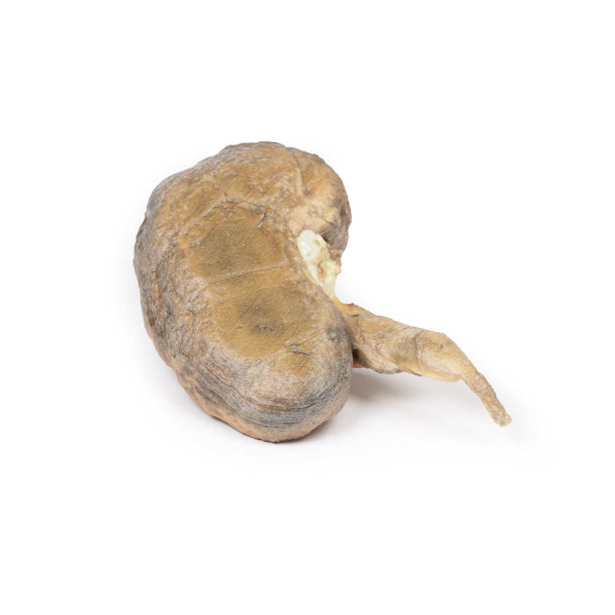 Multiple Renal Calculi | EZ-MP2095 | Sim & Skills Ltd