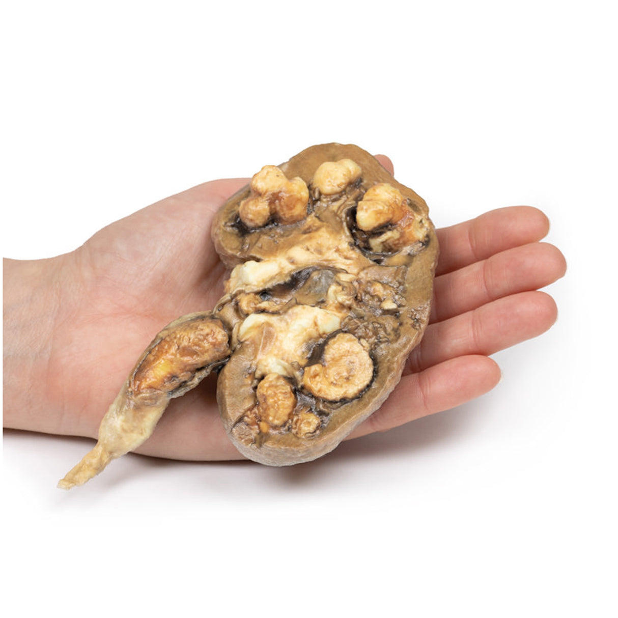 Multiple Renal Calculi | EZ-MP2095 | Sim & Skills Ltd